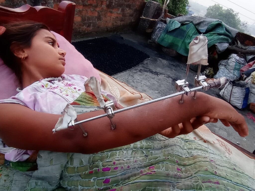 JAMSHEDPUR : कलाई टूटने पर भट्ठा मालिक ने पहले दिया आश्ववासन अब दिखा रहा पीठ, थाना प्रभारी भी नहीं कर रहे मदद