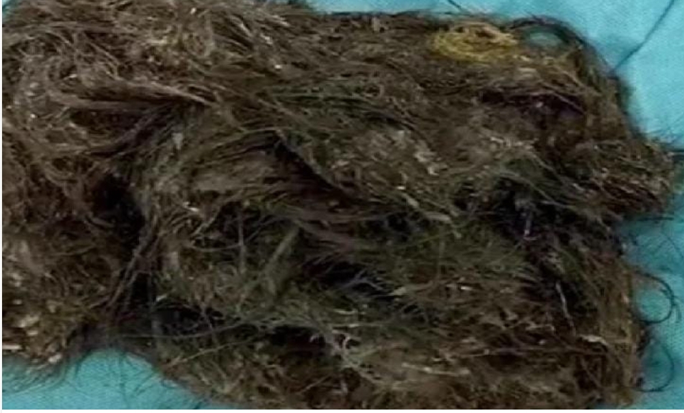 9 साल की बच्ची के पेट से निकला 1.5 किलो बाल, पिछले 7 साल से खा रही थी